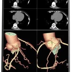 Medizinischer Monitor mit vier CT-Bildern, oben Querschnitte, unten 3D-Darstellung von Gefäßen und Organen.
