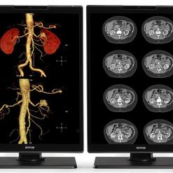 Zwei medizinische Monitore zeigen eine 3D-Darstellung der Nieren und CT-Bilder des Bauchraums nebeneinander.