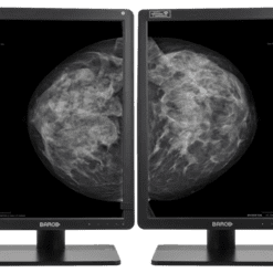 Zwei Monitore zeigen links und rechts Mammografiebilder einer Brust im röntgenähnlichen Stil auf schwarzem Hintergrund.