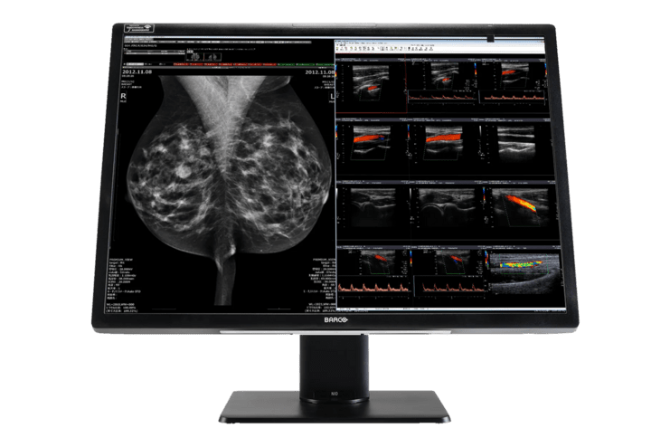 Monitor mit Mammografie- und Ultraschallbildern zur diagnostischen Untersuchung der Brust.