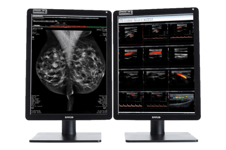 Zwei Computerbildschirme zeigen medizinische Bilder: links Mammographie, rechts Ultraschalluntersuchungen.