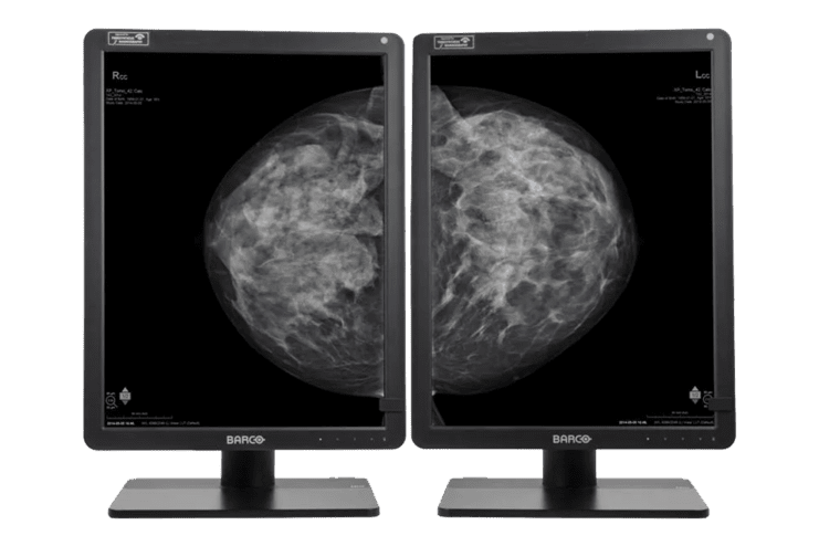 Zwei Monitore zeigen Mammografiebilder von rechts und links, jeweils mit strahlend weißen Bereichen auf schwarzem Hintergrund.
