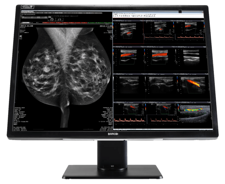 Bildschirm mit Mammografie- und Ultraschallbildern zur Brustuntersuchung auf schwarzem Monitor.