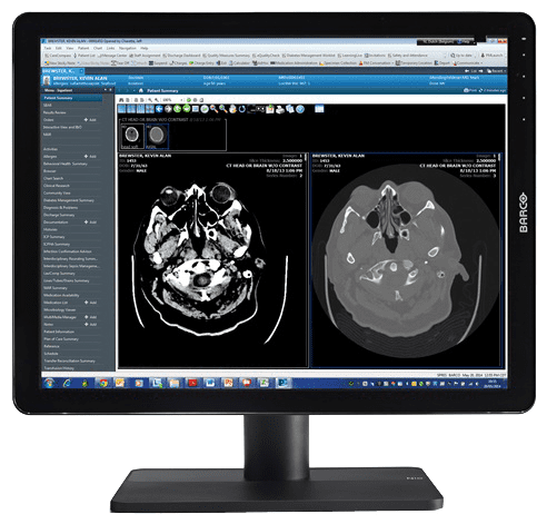 Monitor mit CT-Bildern des Schädels, eine Ansicht zeigt Querschnitt, die andere frontal, auf blauer Softwareoberfläche.