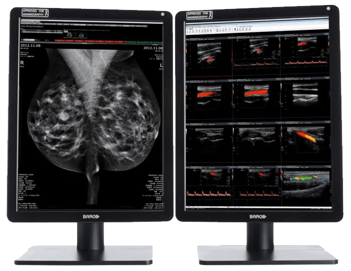 Zwei medizinische Monitore zeigen Mammografie- und Ultraschallbilder zur Analyse von Brustgewebe.