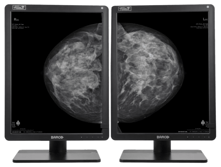 Zwei Monitore zeigen Mammographie-Bilder, rechts und links mit unterschiedlichen Ansichten eines Gesichtsbereichs.