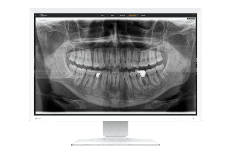R&ouml;ntgenaufnahme eines Unterkiefers mit sichtbaren Z&auml;hnen und zwei fehlenden Z&auml;hnen im Frontbereich auf einem Monitor.
