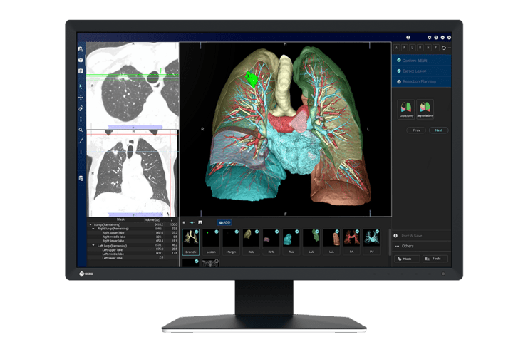 3D-Darstellung der menschlichen Lungen mit dazugeh&ouml;rigen Blutgef&auml;&szlig;en auf einem Monitor, begleitet von R&ouml;ntgenaufnahmen.