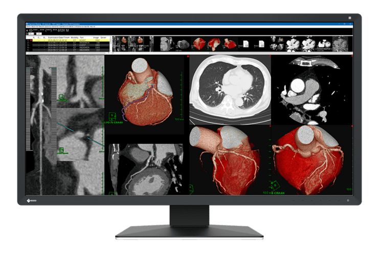 Medizinischer Monitor zeigt CT-Scans des Herzens, inklusive detaillierter 3D-Darstellungen und anatomischer Ansichten.